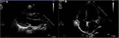 Association between left ventricular remodeling and lipid profiles in obese children: an observational study